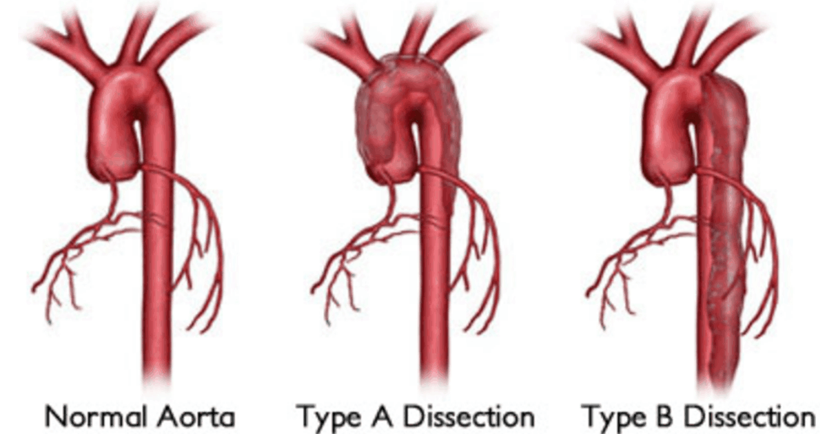 What is an Aortic Dissection? | Patients & Families