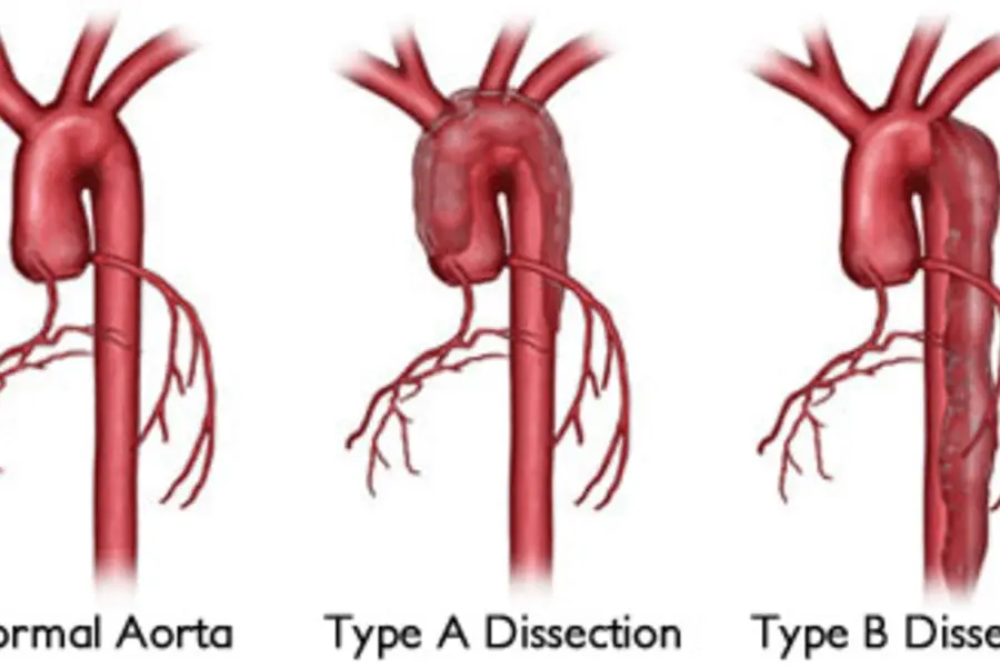 What is an Aortic Dissection?