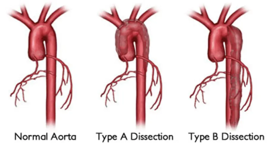 What is an Aortic Dissection?