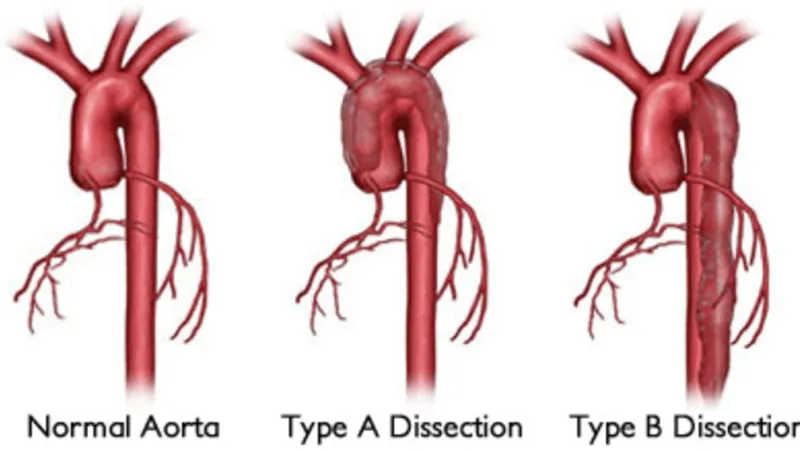 What is an Aortic Dissection?