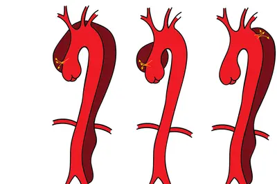 Aortic Dissection Symptoms