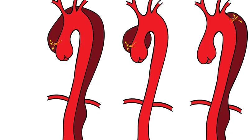 Aortic Dissection Symptoms