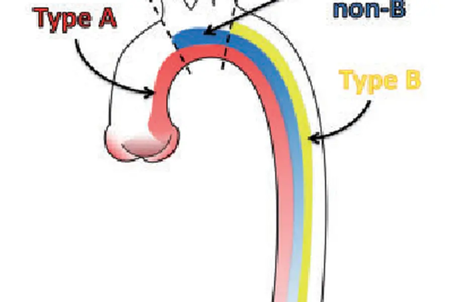 Aortic Dissection Types