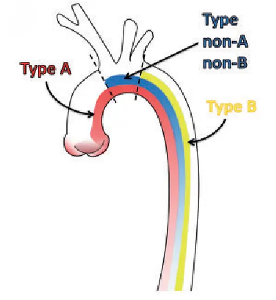 Aortic Dissection Types