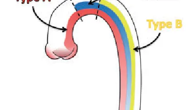 Aortic Dissection Types